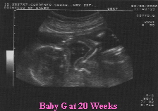 Baby G 20 week scan no 3